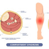 Pedoman Penanganan Sindrom Kompartemen Akut – Ulasan Guideline Terkini