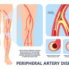Kapan Memilih Aterektomi untuk Penyakit Arteri Perifer?