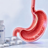 Peran Obat Sitoprotektor pada GERD dan Gastritis