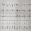 Penanganan Kasus SVT dengan Modified Valsalva Maneuver di IGD Laporan Kasus - Pemenang Kompetisi Poster Dr. RACE Kategori Laporan Kasus