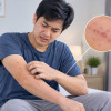 Ivermectin Oral Dosis Tinggi vs Dosis Standar untuk Skabies Berat – Telaah Jurnal Alomedika