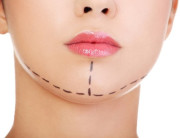 Ketahui 3 Cara Menghindari Operasi Plastik Gagal