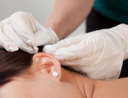 6 Manfaat Terapi Akupunktur untuk Kesehatan