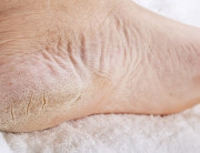 How to Avoid Hot, Burning Feet When Walking or Running