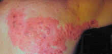 Opsi Analgesik untuk Nyeri Herpes