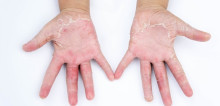Membedakan Dermatitis Kontak Iritan dengan Dermatitis Kontak Alergi