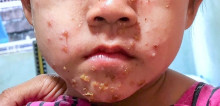 Antibiotik Oral atau Topikal untuk Impetigo