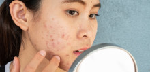 Pedoman Tata Laksana Acne Vulgaris – Ulasan Guideline Terkini