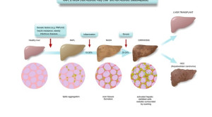 Opsi Terapi Non-alcoholic Fatty Liver Disease (NAFLD) dan Non-alcoholic Steatohepatitis (NASH)