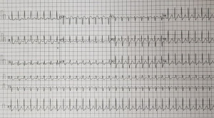 Penanganan Kasus SVT dengan Modified Valsalva Maneuver di IGD Laporan Kasus - Pemenang Kompetisi Poster Dr. RACE Kategori Laporan Kasus