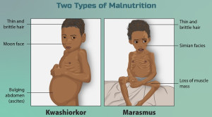 Insidensi Malnutrisi Berat yang dirawat di RSUD dr. P. P. Magretti Saumlaki - Pemenang Kompetisi Poster Dr. RACE Kategori Penelitian