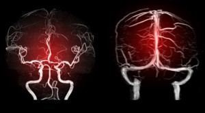 Trombosis Vena Serebri dan Trombosis Vena Porta Pasca COVID-19 - Telaah Jurnal Alomedika