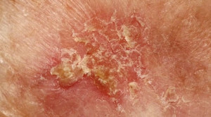 Perbedaan Keratosis Aktinik dengan Karsinoma Sel Skuamosa