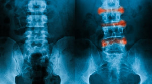 Hubungan antara Homosistein dengan Ankylosing Spondylitis – Telaah Jurnal Alomedika