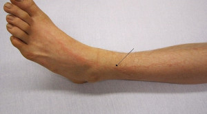 Tampilan Klinis dan Manajemen Lichtenberg Figure