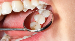 เคลือบหลุมร่องฟัน วิธีป้องกันฟันผุได้อย่างมีประสิทธิภาพ