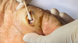 Asam Asetat Sebagai Alternatif Perawatan Luka Kronik