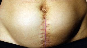 Suture Lebih Unggul dibandingkan Stapler pada Sectio Caesarean