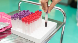 Hasil Positif Palsu pada Pemeriksaan HIV Generasi Keempat