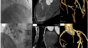 Pemeriksaan Coronary Computed Tomography Angiography untuk Nyeri Dada