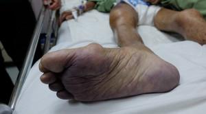 Risiko Acute Limb Ischemia akibat COVID-19