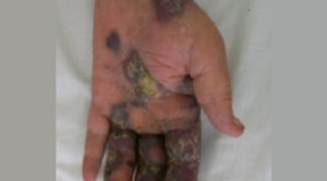 Manifestasi Penyakit Kulit pada Pasien HIV/AIDS