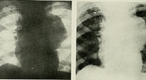 Pelebaran Mediastinum pada Rontgen Thorax Pasien Dewasa