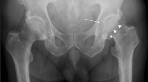 Injeksi Glukokortikoid dan Osteoarthritis - Telaah Jurnal Alomedika