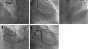 PCI Tidak Efektif untuk Angina Stabil - Telaah Jurnal Alomedika