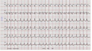 Skoring untuk Deteksi Stroke karena Atrial Fibrilasi – Telaah Jurnal