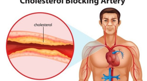 Perbandingan Efikasi Dan Keamanan Obat Antara Agen Penurun Lipid Pada Pasien Hiperkolesterolemia: Meta-analisis Frequentist Network – Telaah Jurnal