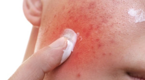 Terapi Akne Vulgaris dengan Topikal Kombinasi Nicotinamide, ABA dan ZnPCA