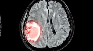 Kontroversi Penurunan Tekanan Darah pada Fase Akut Stroke Hemoragik
