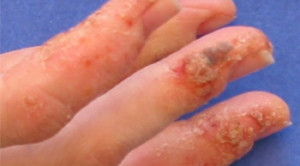 Salah Kaprah Pemberian Antibiotik untuk Dyshidrotic Eczema