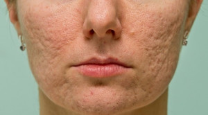 Pilihan Terapi untuk Atrophic Acne Scar