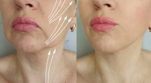 Manfaat dan Profil Risiko Stem Cell Facelift