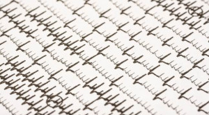 Risiko Atrial Fibrilasi pada Pasien Asthma