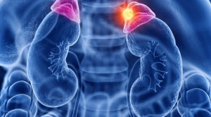 Tumor Adrenal yang Ditemukan Tidak Sengaja pada Pemeriksaan Radiologi