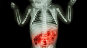 Probiotik untuk Pencegahan Necrotizing Enterocolitis