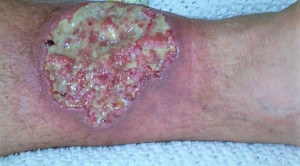 Membedakan Pyoderma Gangrenosum dari Gangrene