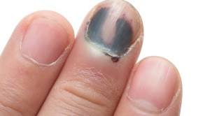 Perbandingan Manajemen Hematoma Subungual