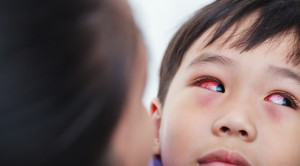 Pemeriksaan Klinis Konjungtivitis Viral vs Bakterial