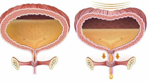 Red Flag Retensi Urine