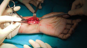 Surgical Plating VS Reduksi Tertutup dalam Penatalaksanaan Fraktur Radius Distal Lansia – Telaah Jurnal Alomedika