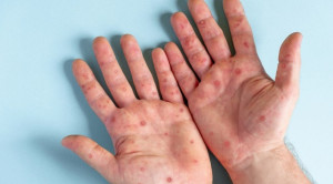 ถาม-ตอบเรื่องโรคฝีดาษลิง (Monkeypox)