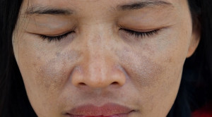 Penyakit Addison akibat Tuberkulosis