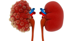 Tambahan Asupan Air untuk Pasien Autosomal Dominant Polycystic Kidney Disease