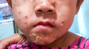 Antibiotik Oral atau Topikal untuk Impetigo