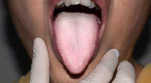 Red Flag Oral Thrush