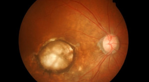 Brolucizumab untuk Terapi Wet Age-related Macular Degeneration